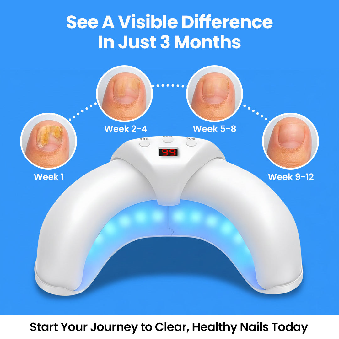 LumiCasa™ Fungal Nail Laser Device