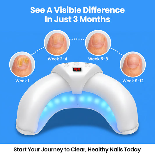 LumiCasa™ Fungal Nail Laser Device