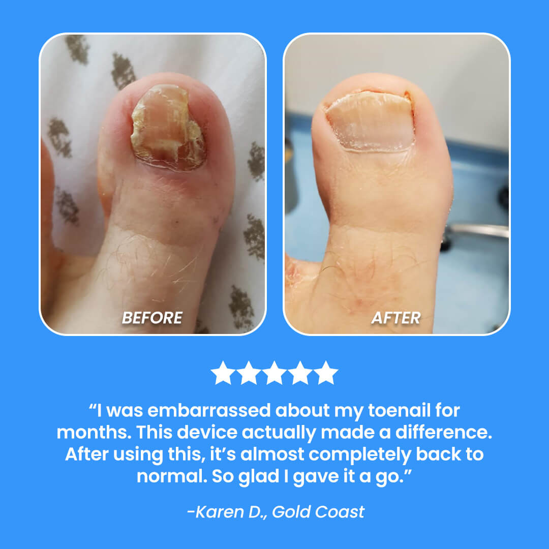 Nail Fungal Cleaning Laser Device