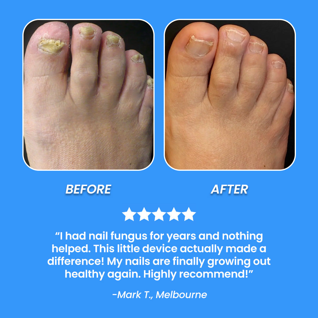 LumiCasa™ Fungal Nail Laser Device