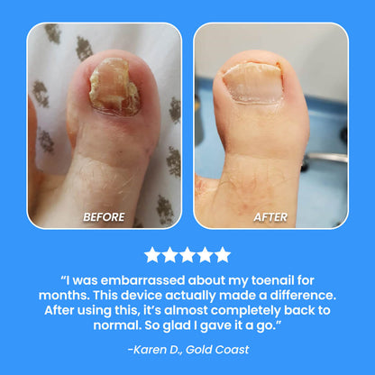 Nail Fungal Cleaning Laser Device